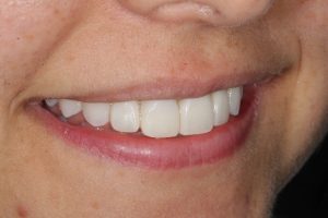 invisalign-composite-bonding-5