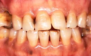 what-are-turkey-teeth