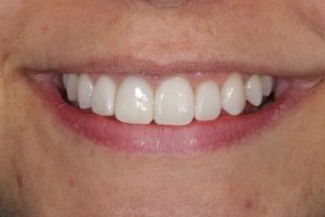 invisalign-composite-bonding-3