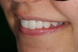 invisalign-composite-bonding-6