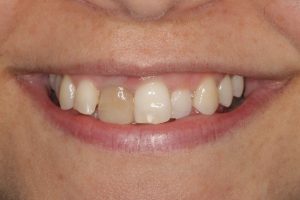 invisalign-composite-bonding-1