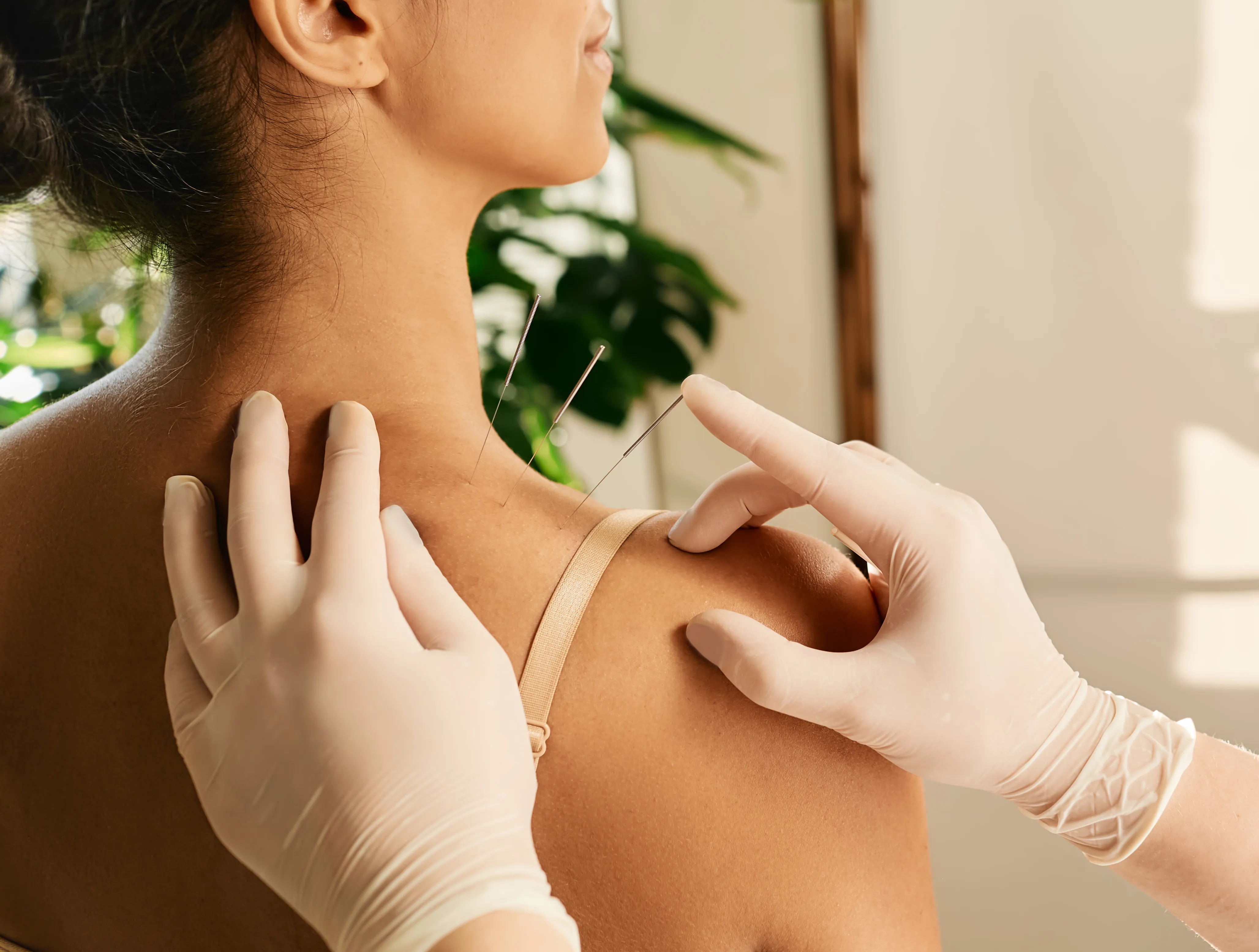 Therapist wearing green jacket performing dry needling on a patient's back.