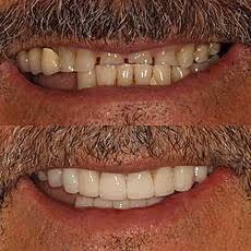 Before and after full mouth rehabilitation case at Ortega Cottage Dentistry