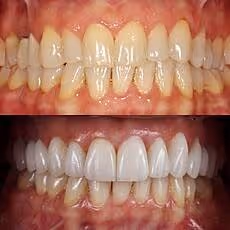 Before and after professional teeth whitening showing dramatically brighter uniform shade at Ortega Cottage Dentistry