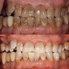 Before and after periodontal treatment and cosmetic refinement at Ortega Cottage Dentistry