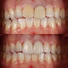 Before and after cosmetic bonding and teeth whitening showing even tone and improved alignment at Ortega Cottage Dentistry