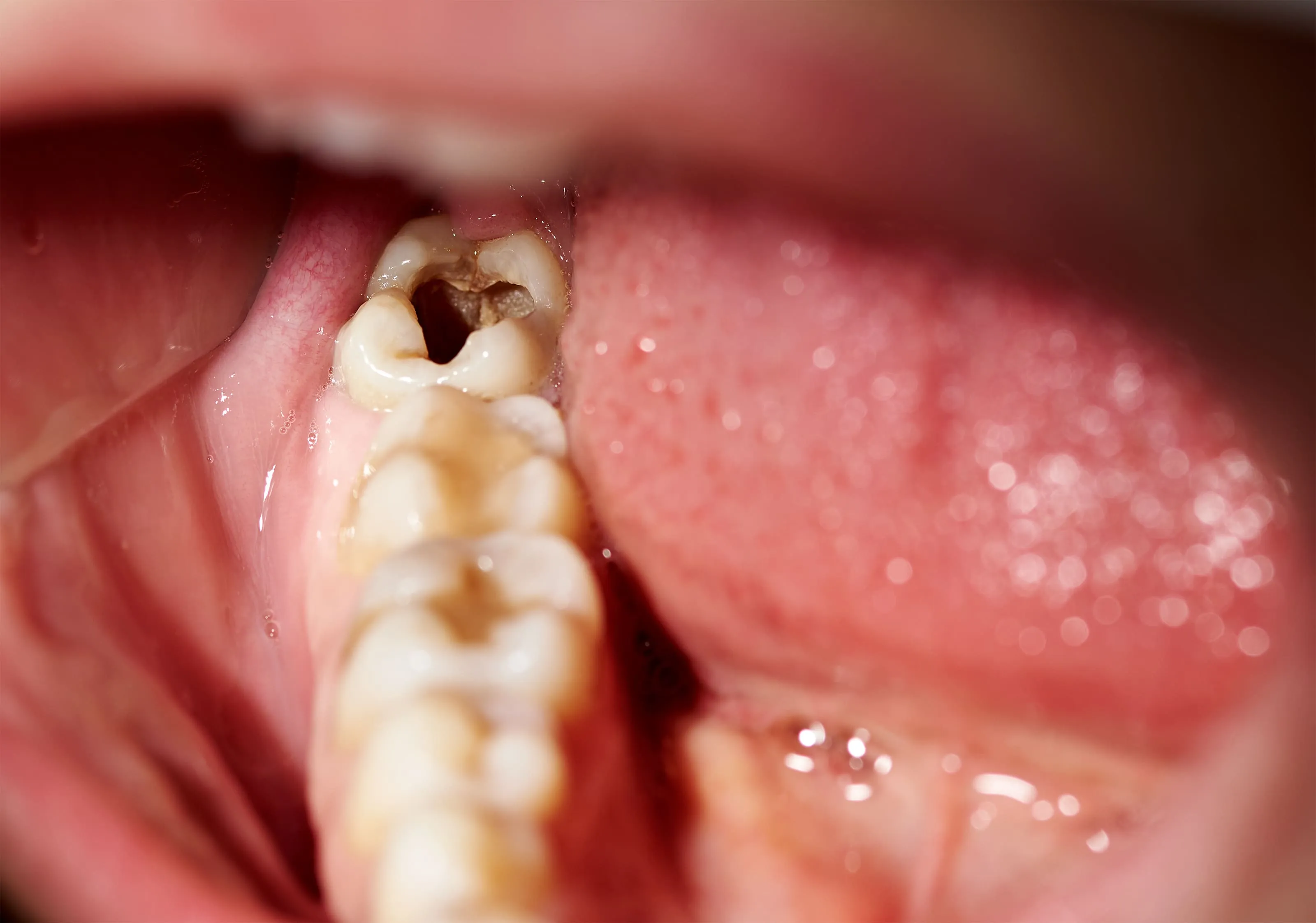 Close-up intraoral view of a severely decayed and damaged molar with visible signs of infection, illustrating when tooth extraction is necessary