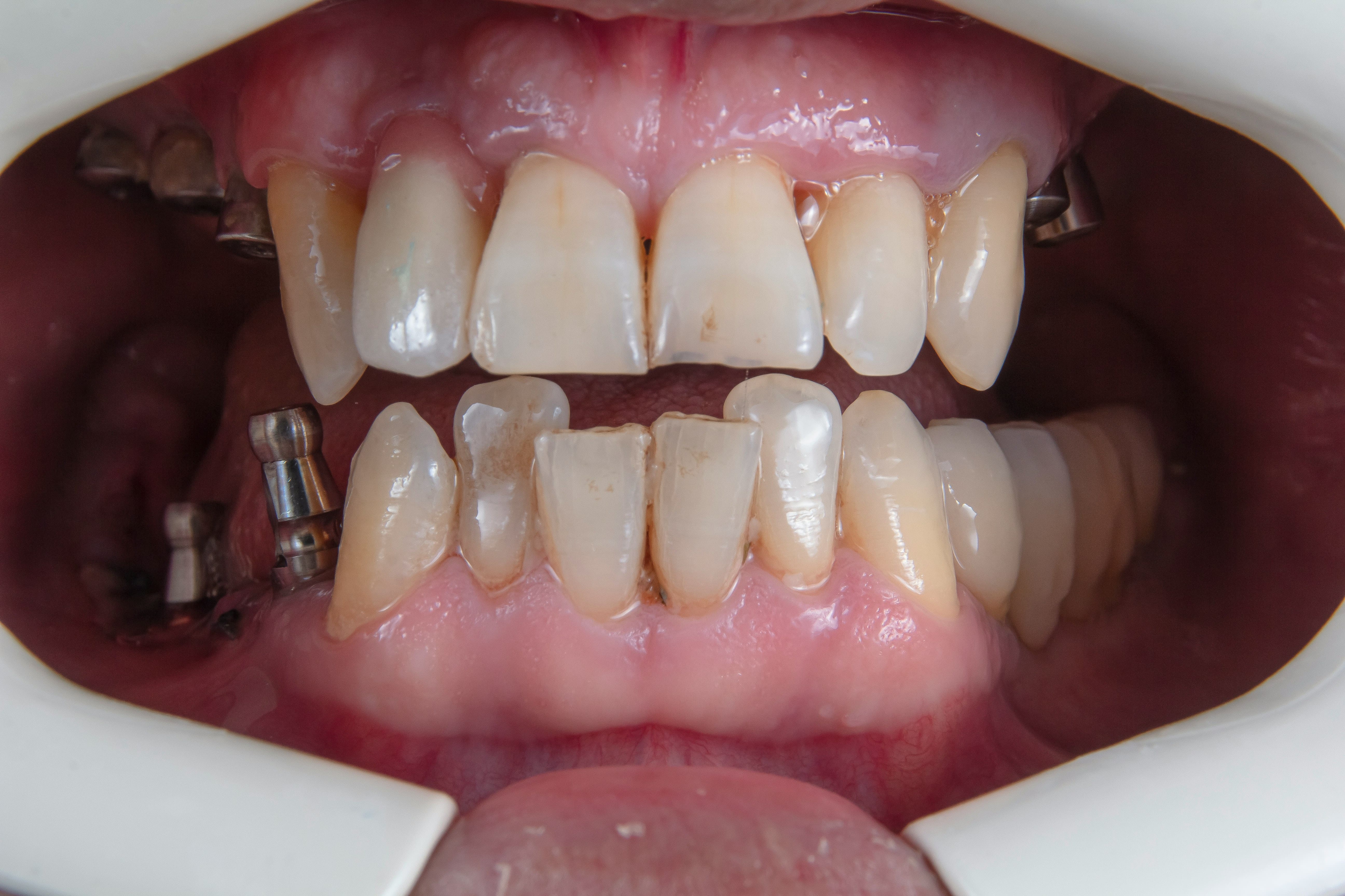 close up of patient teeth with discoloration, tartar, plaque, and with bone and gum recession around dental implant