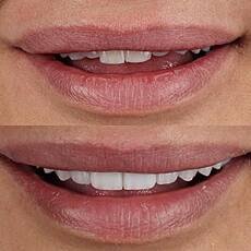 Before and after cosmetic veneer treatment showing refined edge detail and natural proportions at Ortega Cottage Dentistry