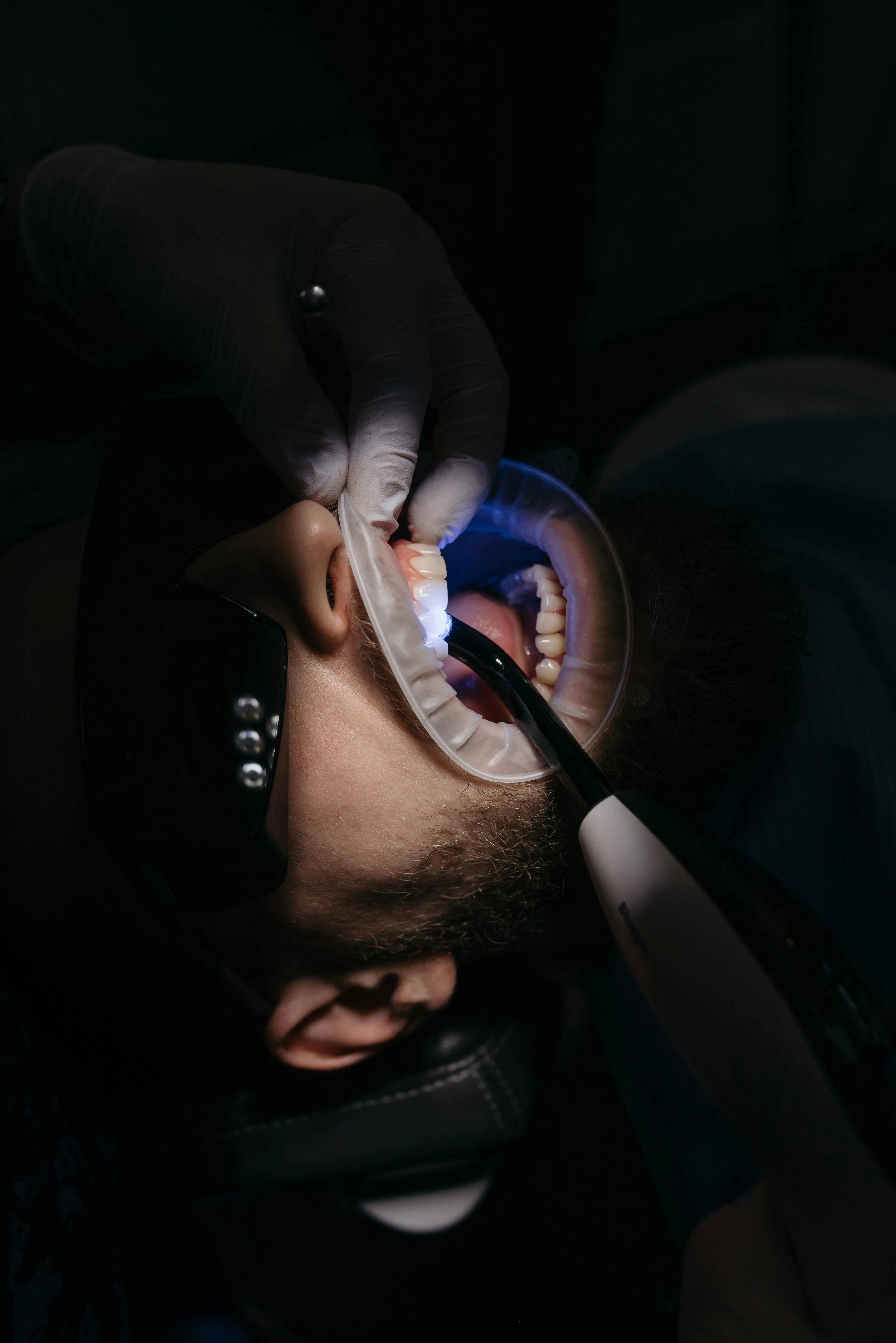 Person receiving dental treatment with mouth held open and blue light curing dental material.