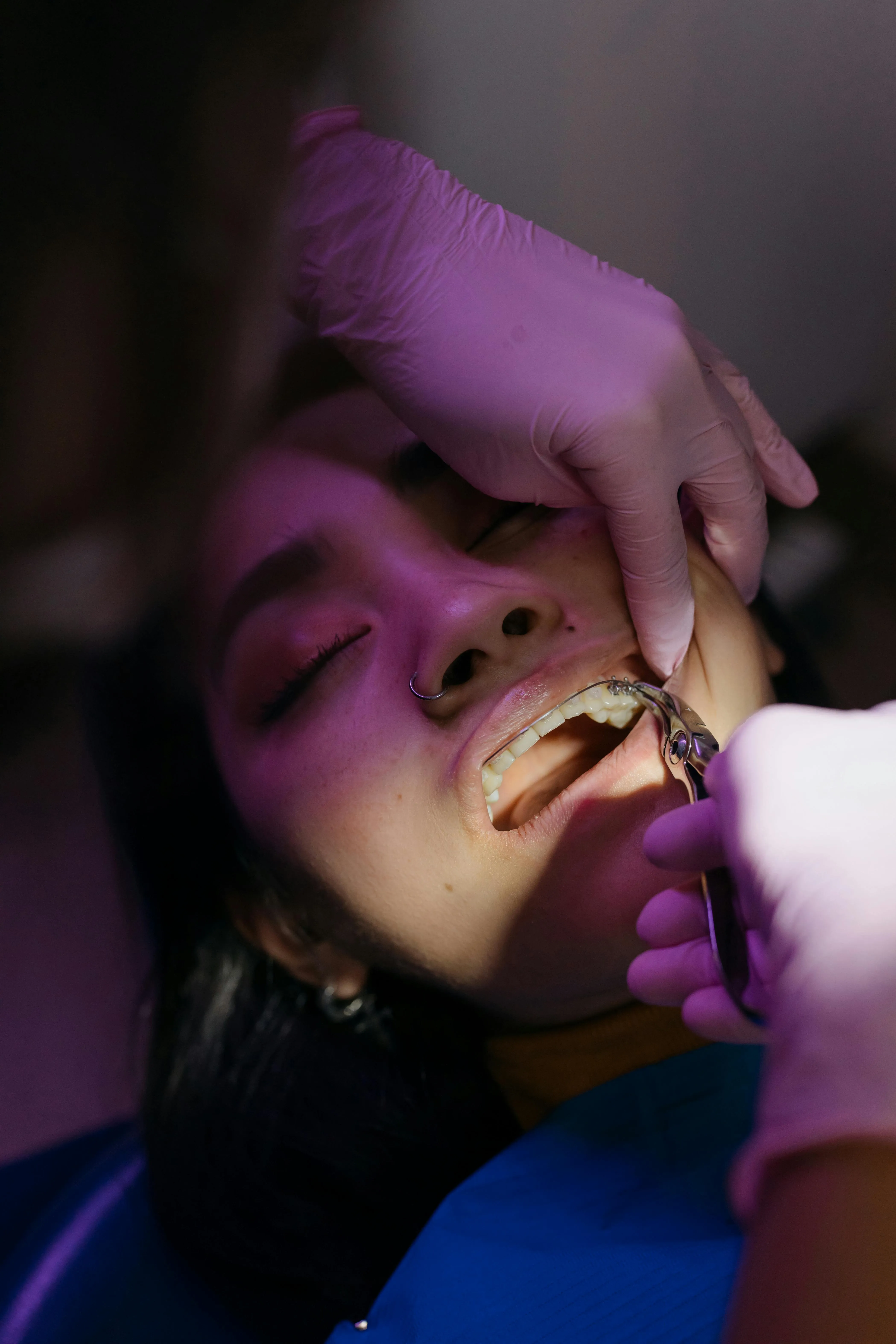 Close-up of dental extraction with gloved hands removing a lower tooth from patient.