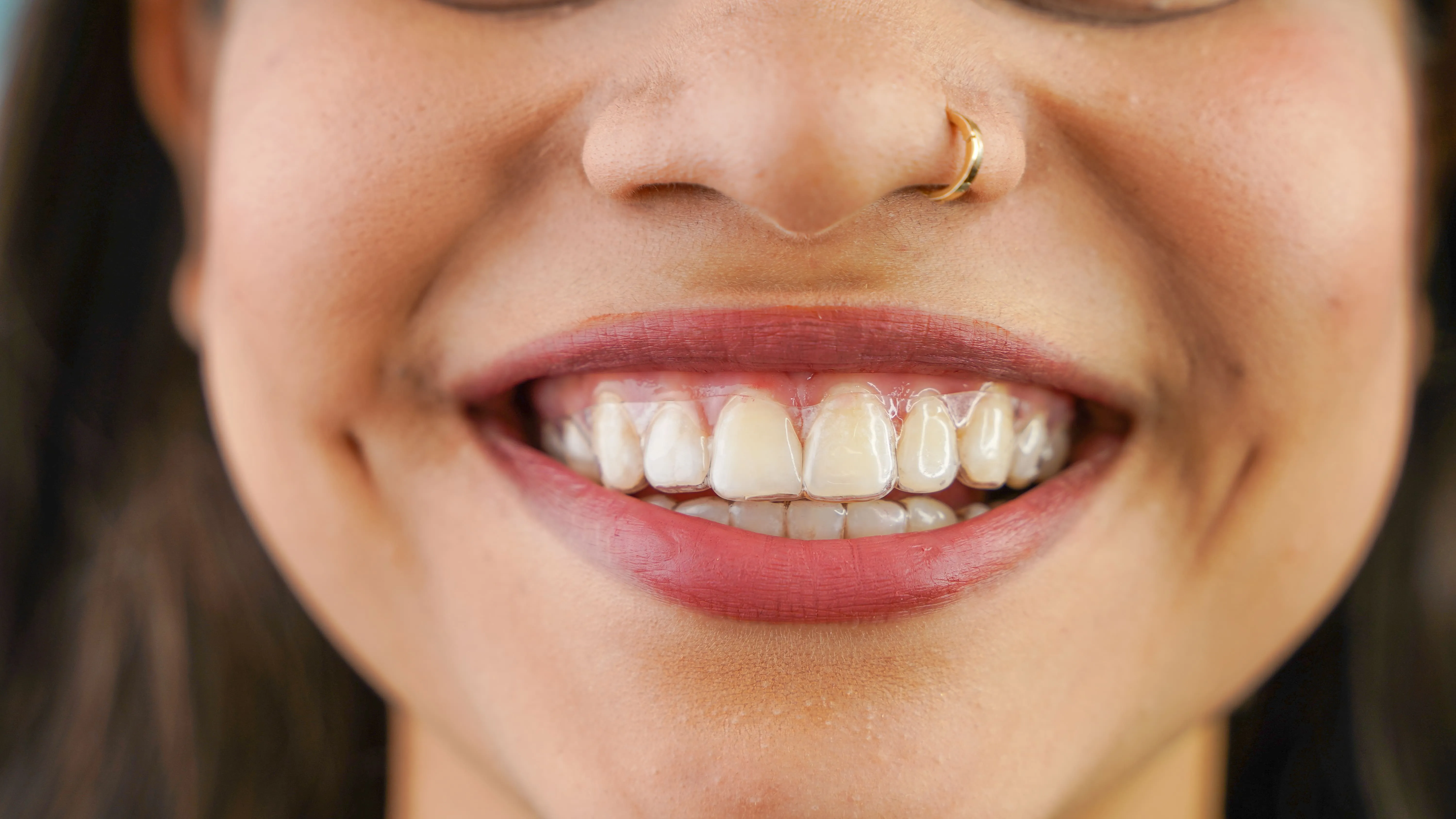 Close-up of a patient smiling while wearing clear aligners
