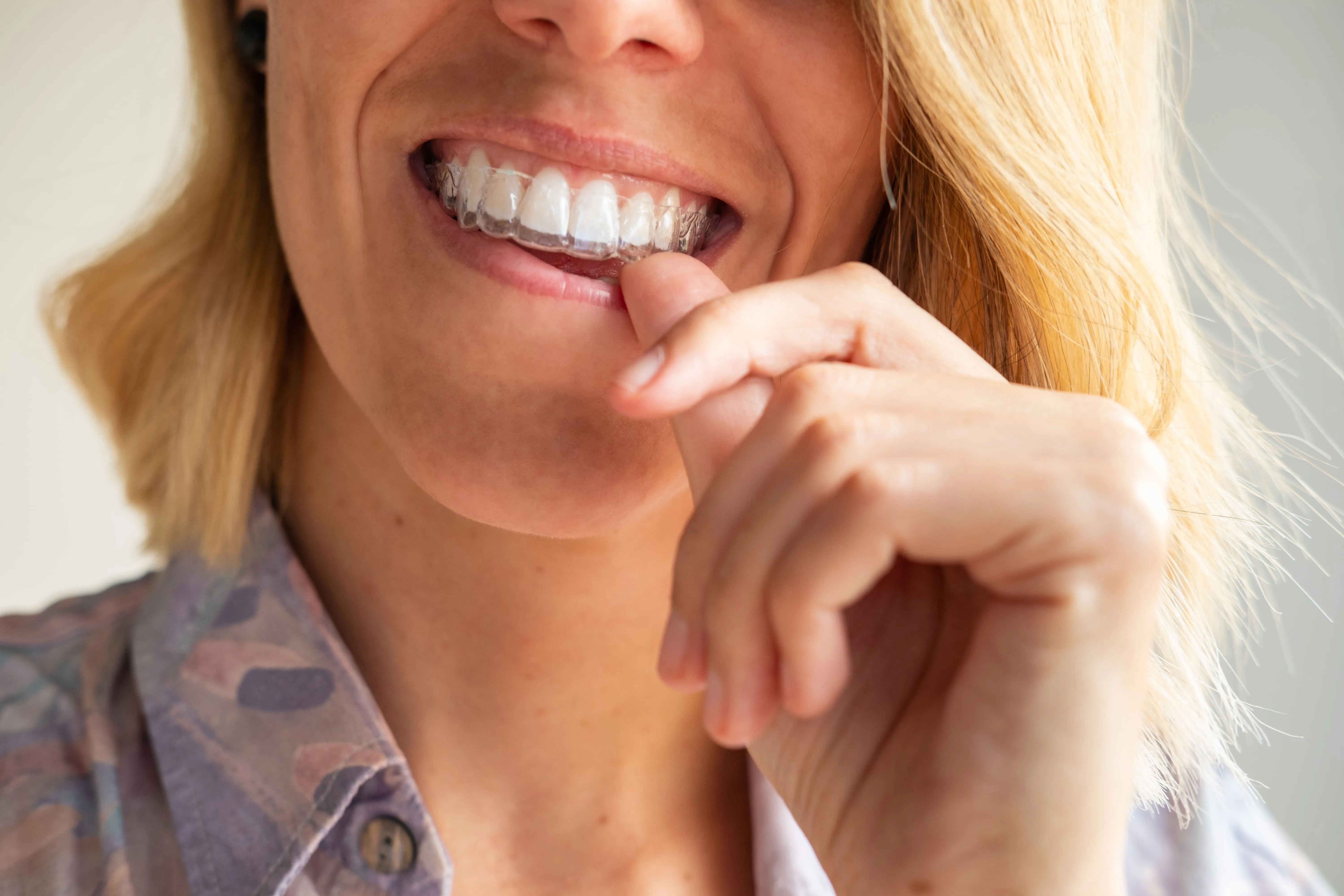 Dental professional using an intraoral scanner on a patient while a 3D digital tooth model is displayed on a monitor, representing the precision scanning process used to create custom Invisalign® clear aligners at Ortega Cottage Dentistry