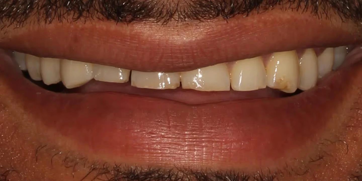 Before porcelain veneers: worn, uneven and discolored front teeth