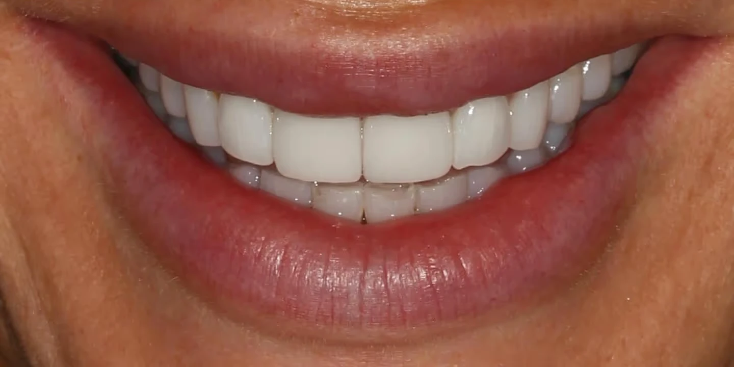 After smile refinement: refined shape and shade