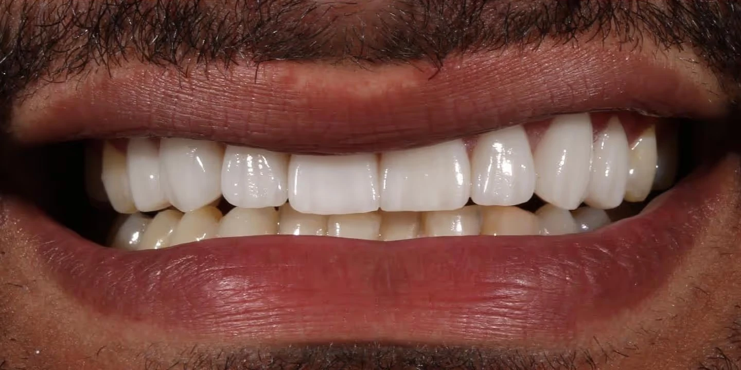 After porcelain veneers: even, bright, natural-looking smile
