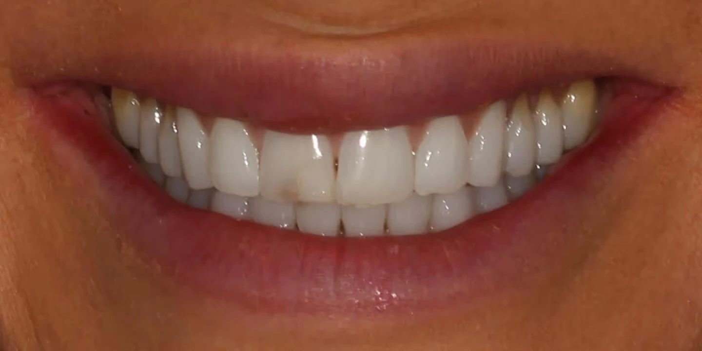 Before smile refinement