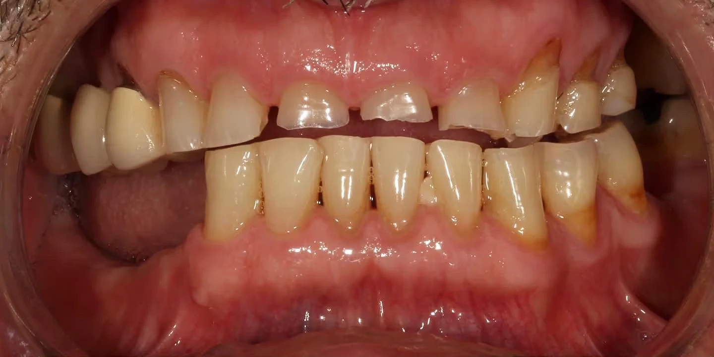 Before full mouth rehabilitation: missing and broken teeth