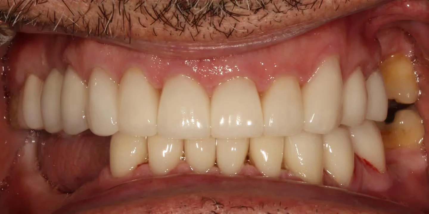 After full mouth rehabilitation: complete, restored smile