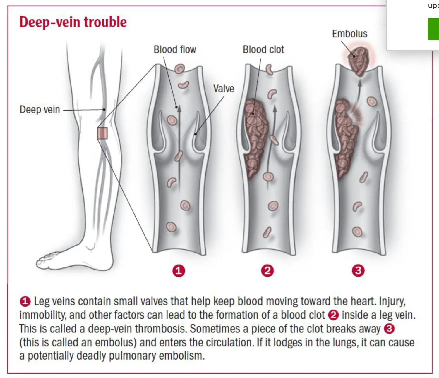Deep-Vein-Thrombosis.jpg