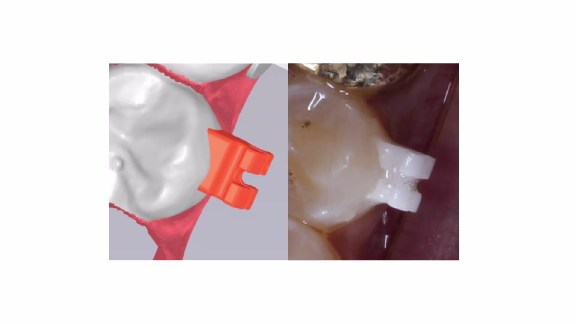 Is your custom-braces system truly customized?