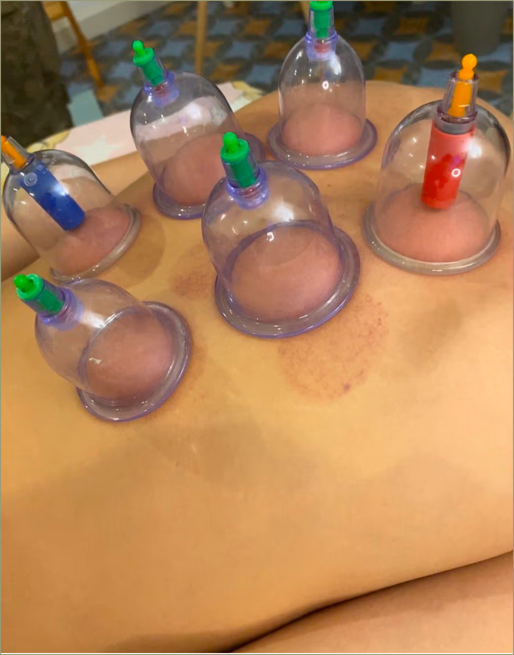 банки на спині