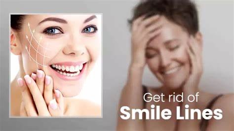 Smile Lines & Folds treatment at SkinHealth in Coral Gables