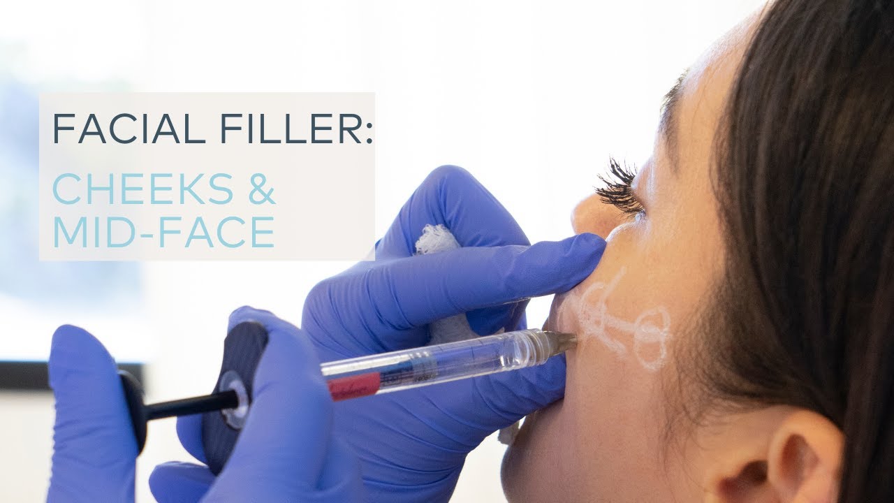 Cheeks & Mid-Face treatment at SkinHealth in Coral Gables