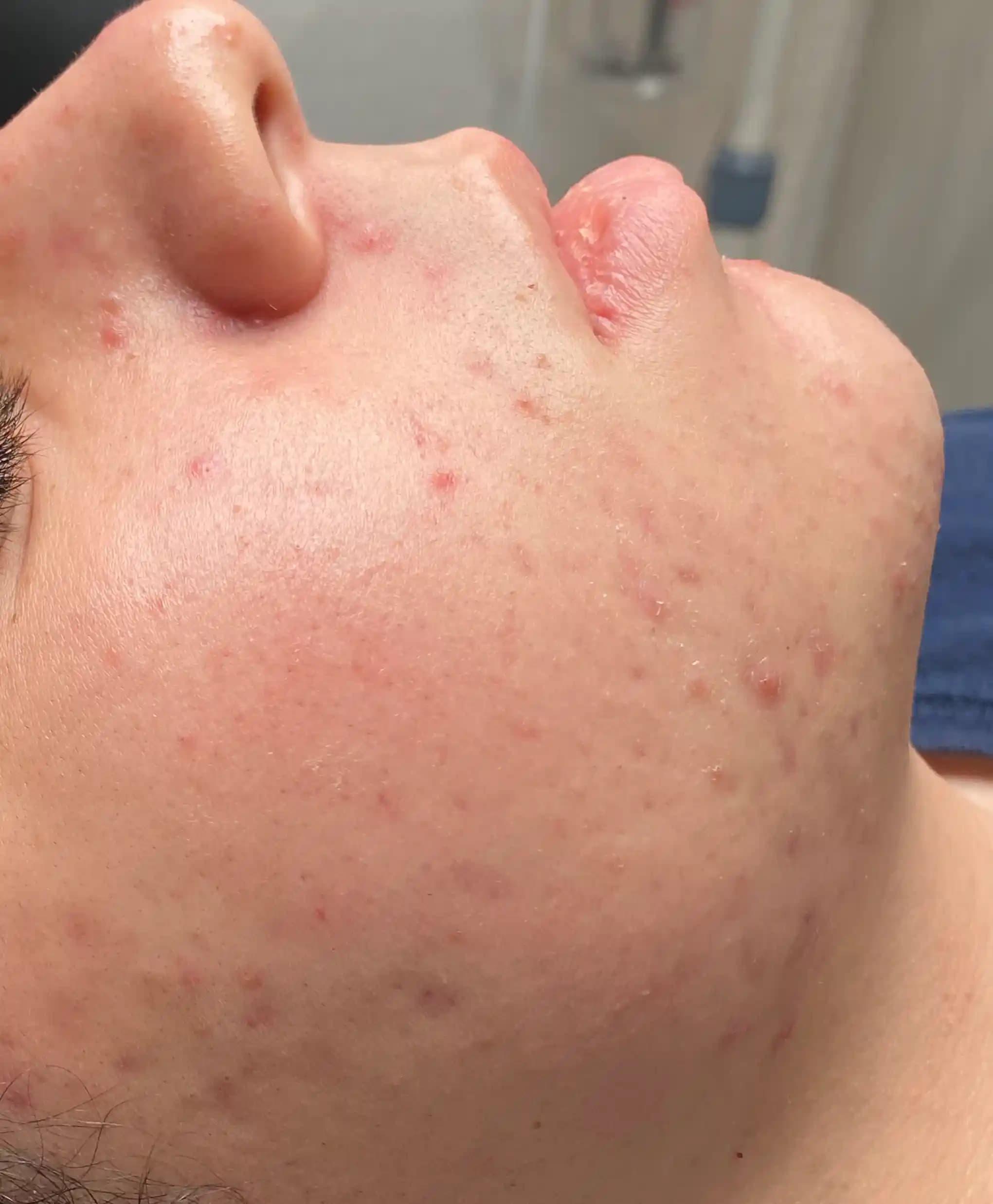 Skinpen Microneedling with Salmon DNA treatment at SkinHealth in Coral Gables