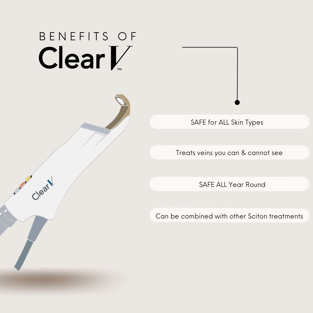Clear V Laser Vein Removal treatment at SkinHealth in Coral Gables