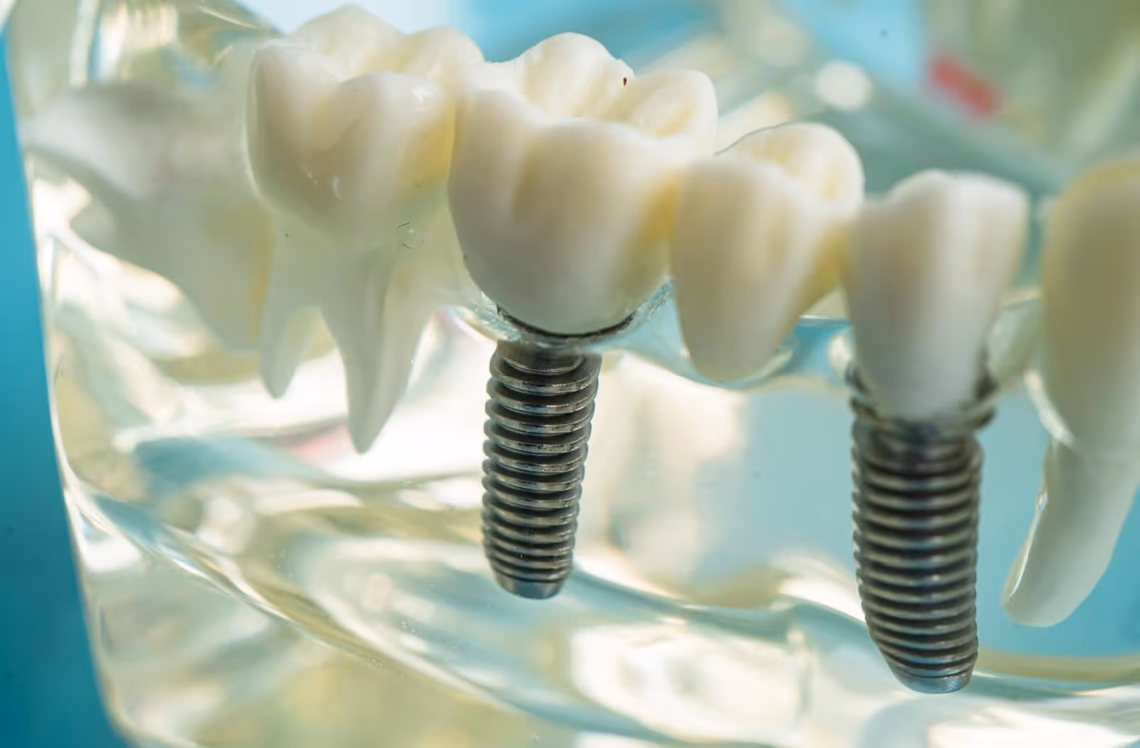 What Parts of a Dental Implant Are Usually Covered?