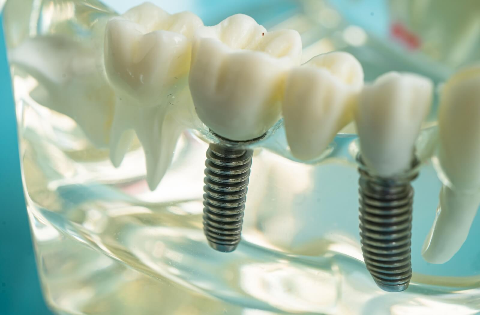 What Parts of a Dental Implant Are Usually Covered?