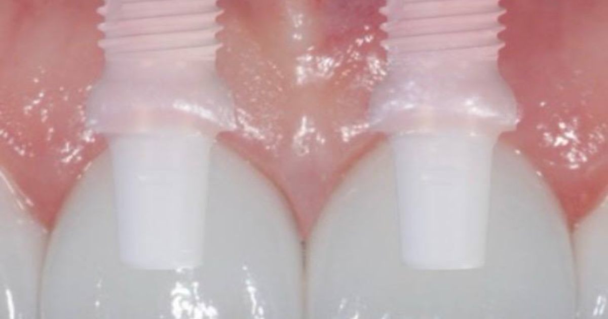 Start Smiling Dental Implant Centers