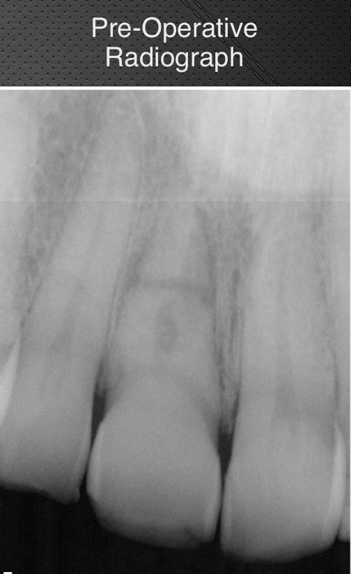 Pre-Operative Radiograph