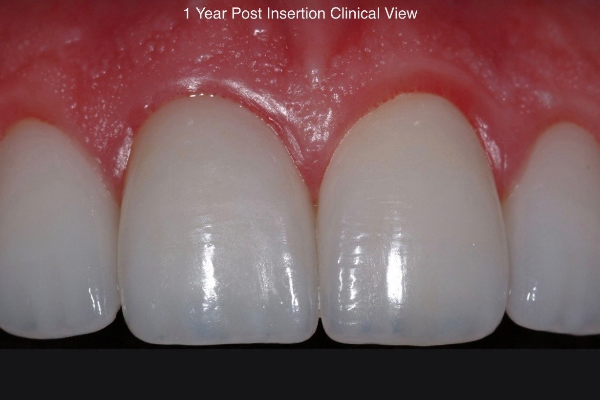 1 Year Post Insertion