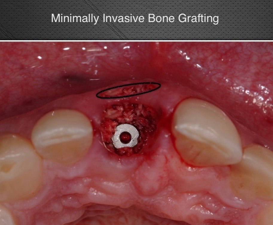 Bone Grafting