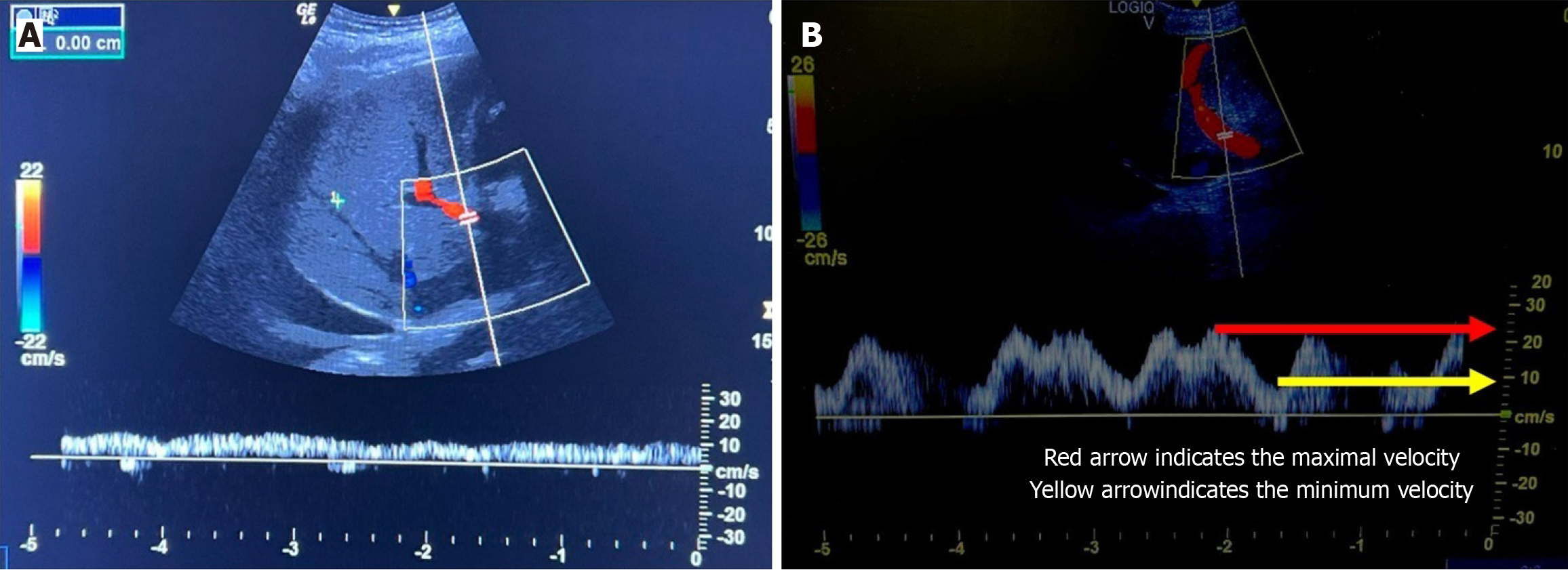 Figure 8 Examples of the portal vein Doppler waveform