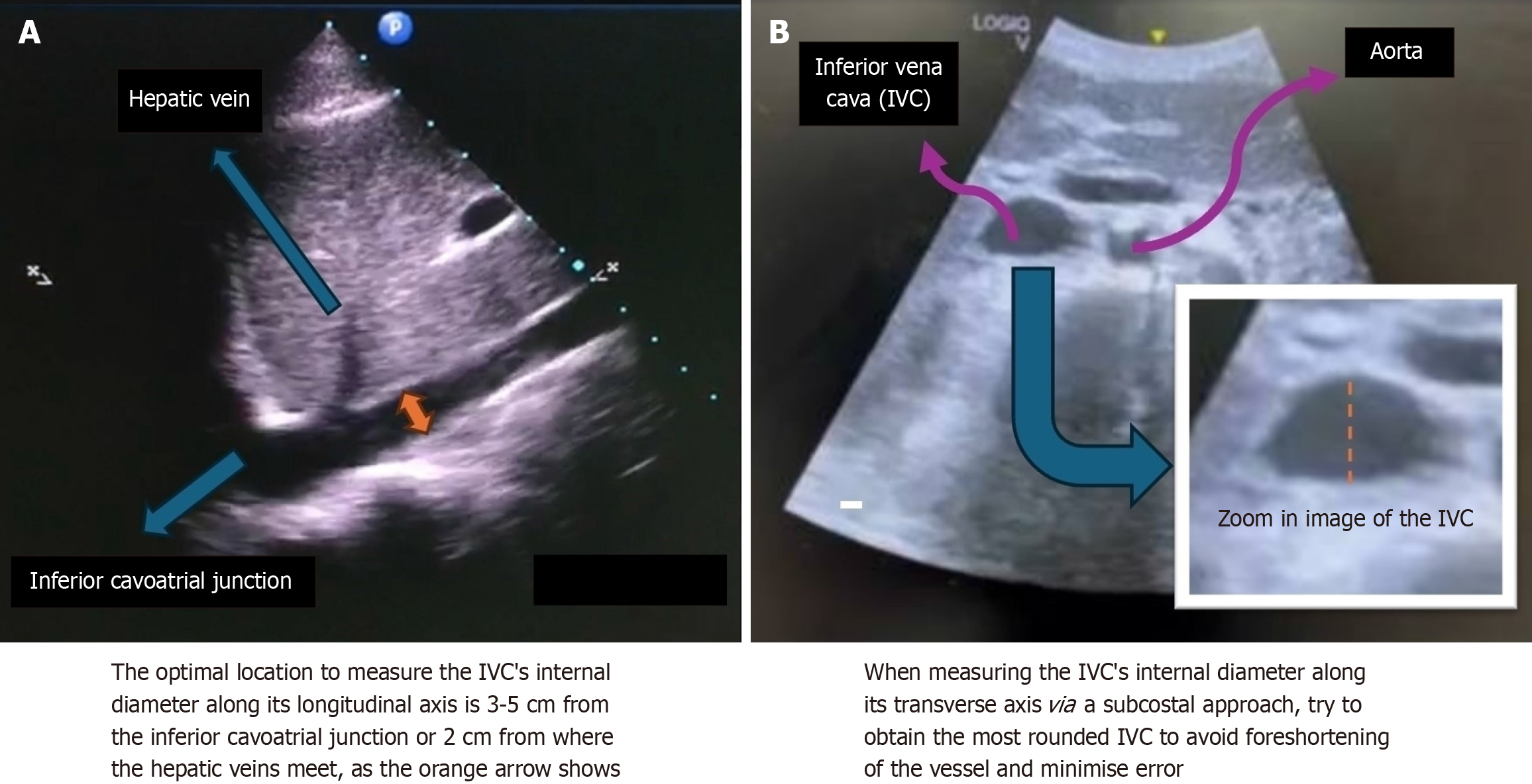 Figure 4 Inferior vena cava images obtained via the subcostal approach