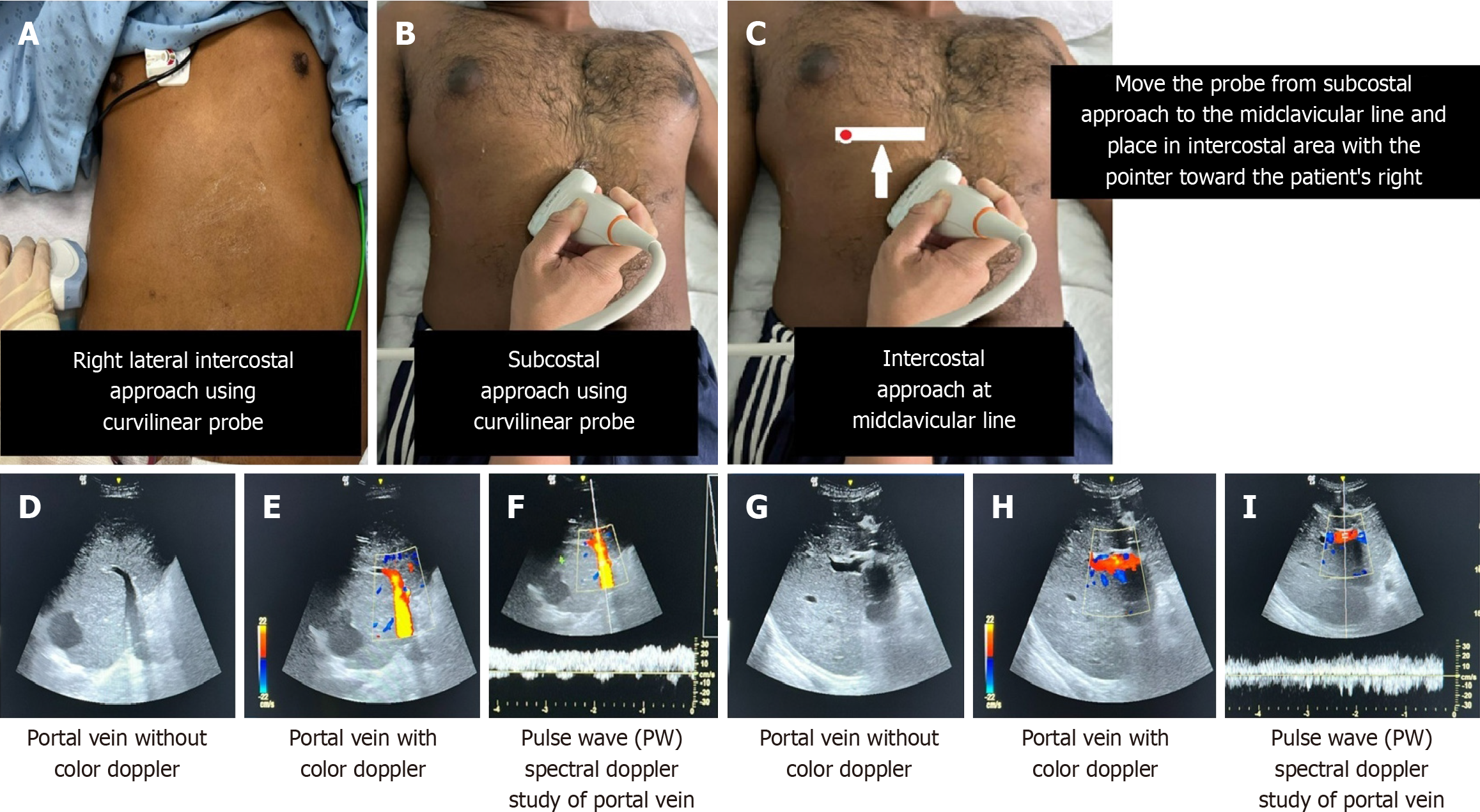 Figure 6 Measures for locating the portal vein using a curvilinear probe and performing a pulse wave spectral Doppler study on the portal vein