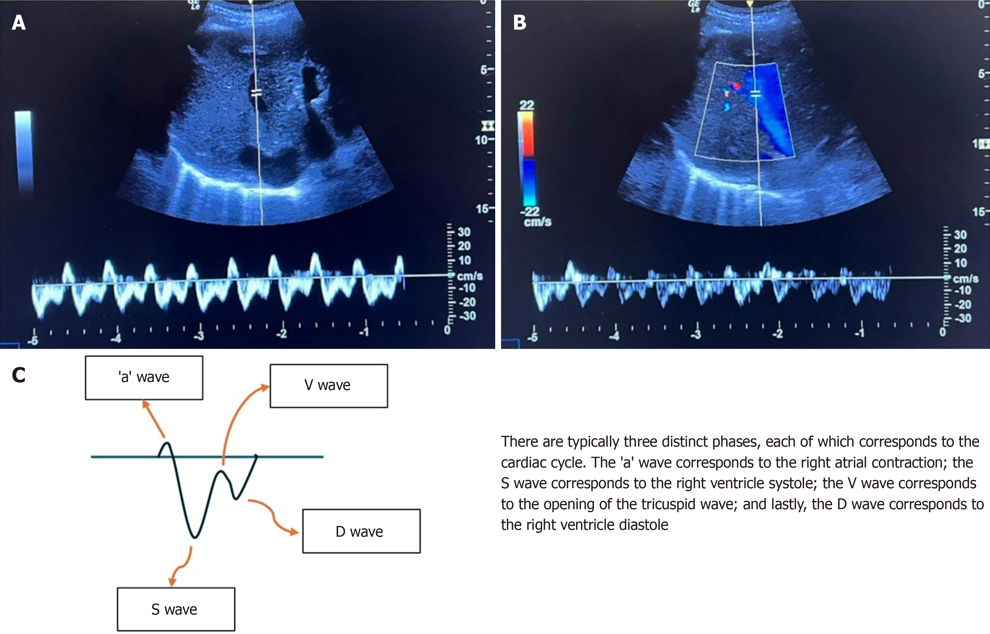 Figure 7 The morphology of the hepatic vein pulse-wave Doppler waveform in a normal condition