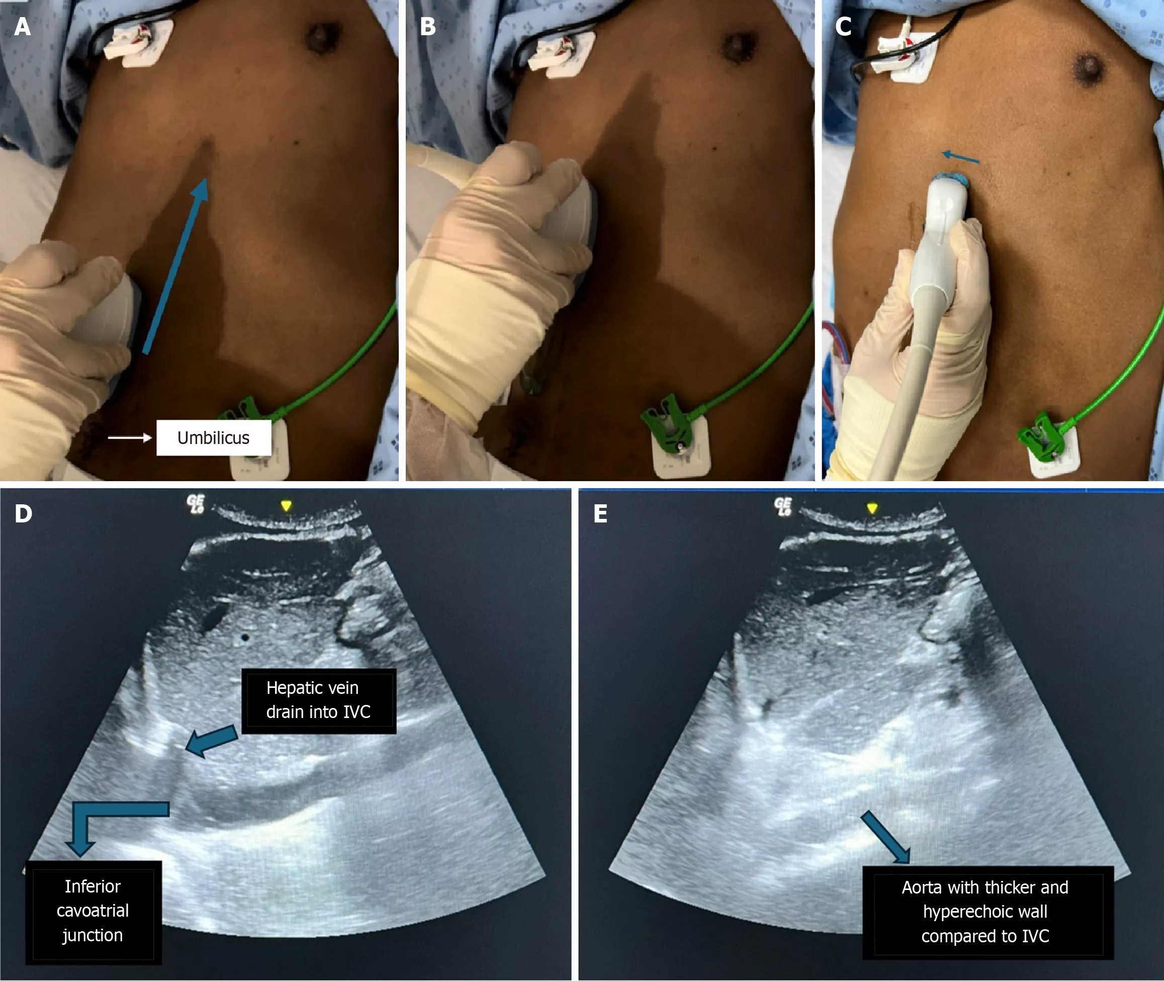 Figure 2 Measures for locating the inferior vena cava using a curvilinear probe