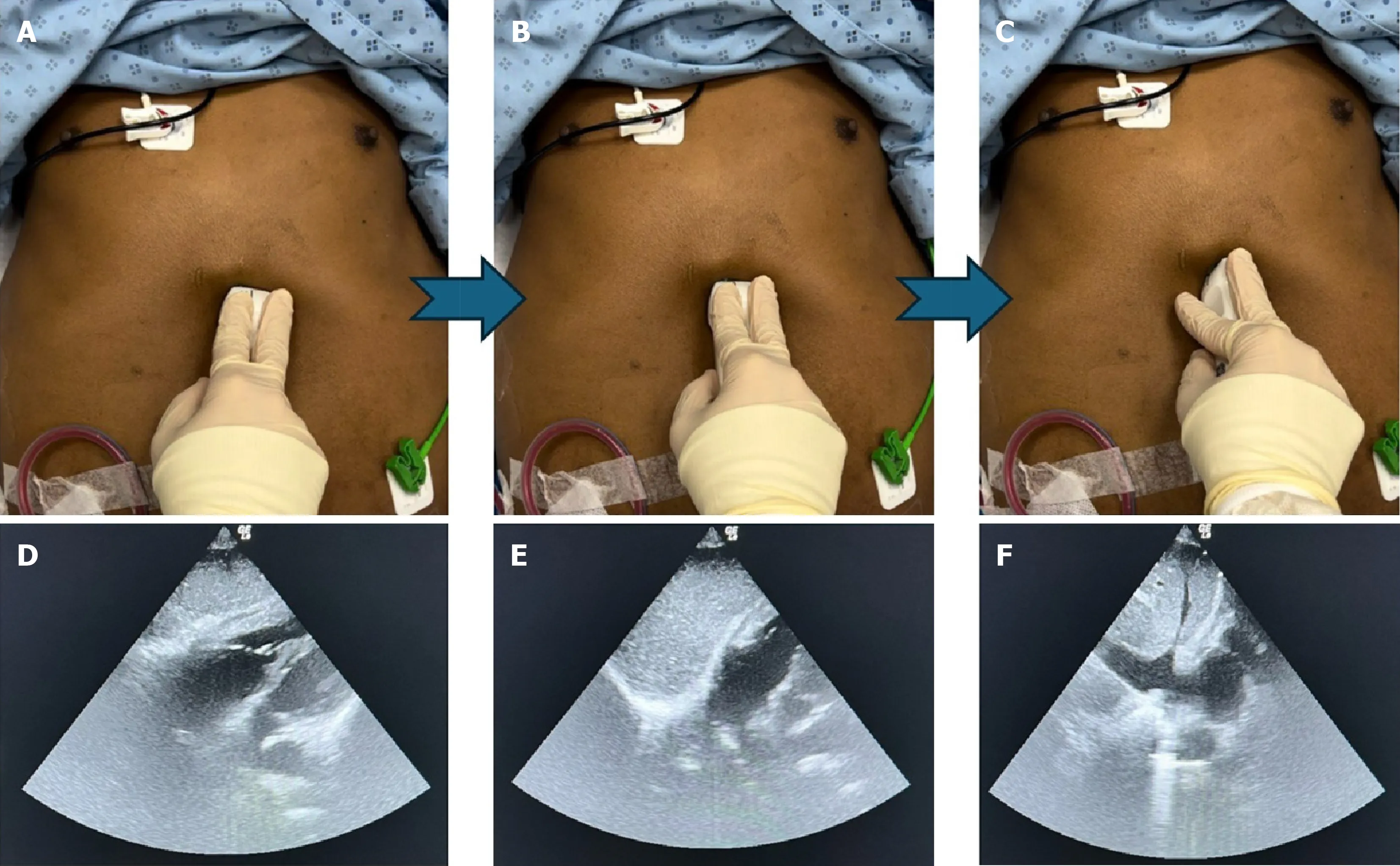 Figure 3 Measures for locating the inferior vena cava using a phased array probe