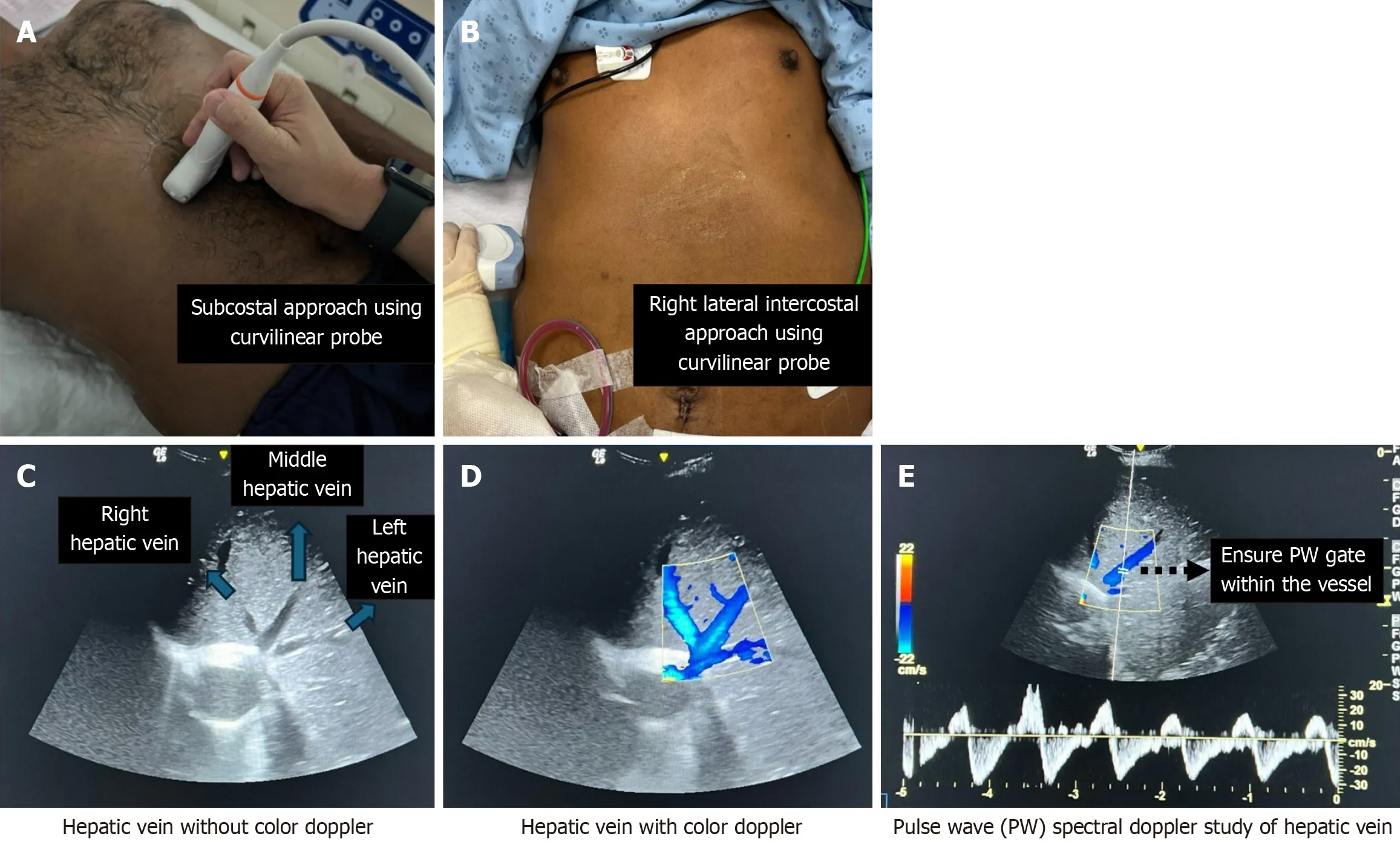 Figure 5 Measures for locating the hepatic vein using a curvilinear probe and performing a pulse wave spectral Doppler study on the hepatic vein