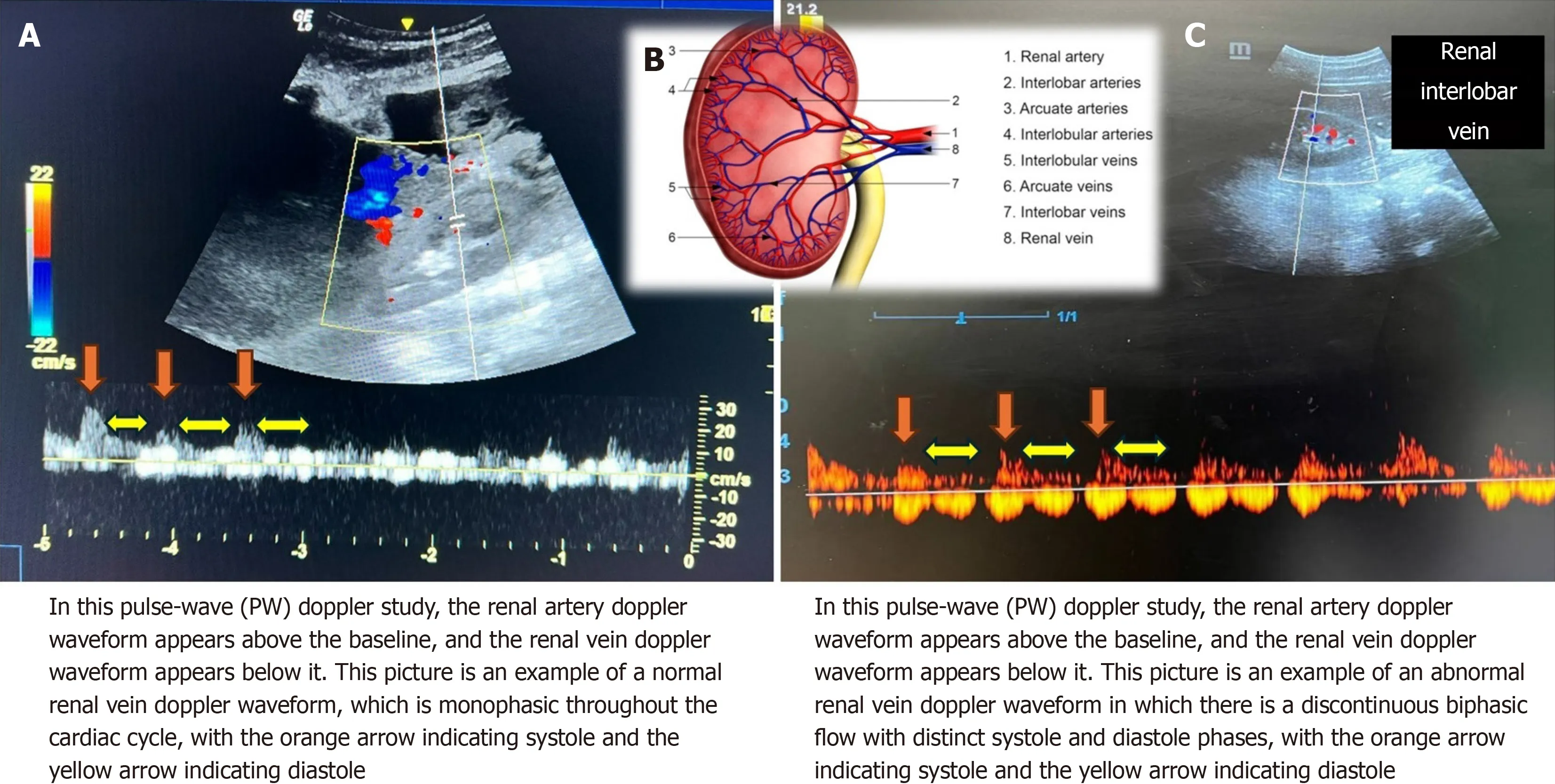 Figure 9 Examples of the renal vein Doppler waveform