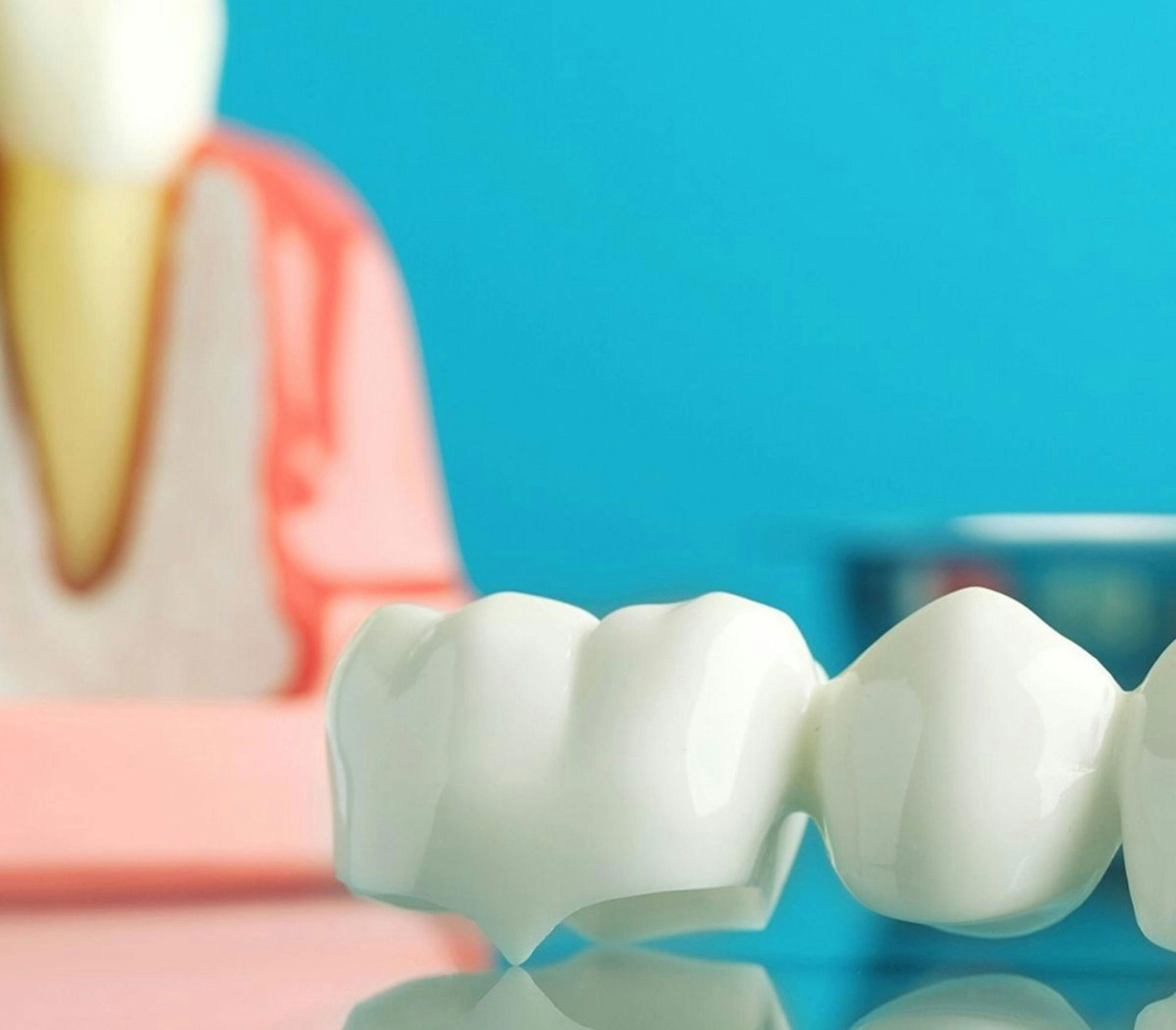 εμφύτευμα ή γέφυρα