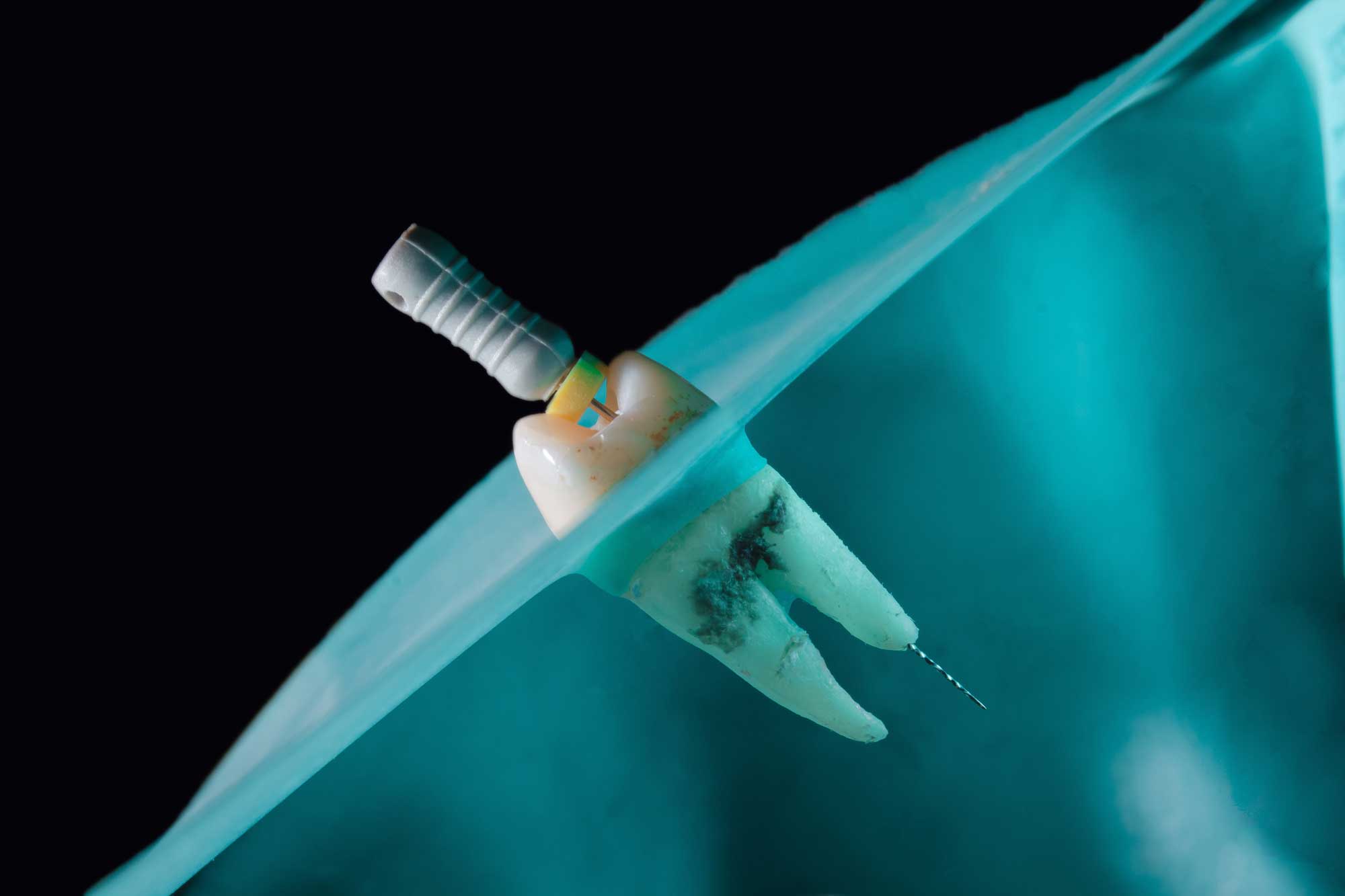 μύθοι για την απονεύρωση