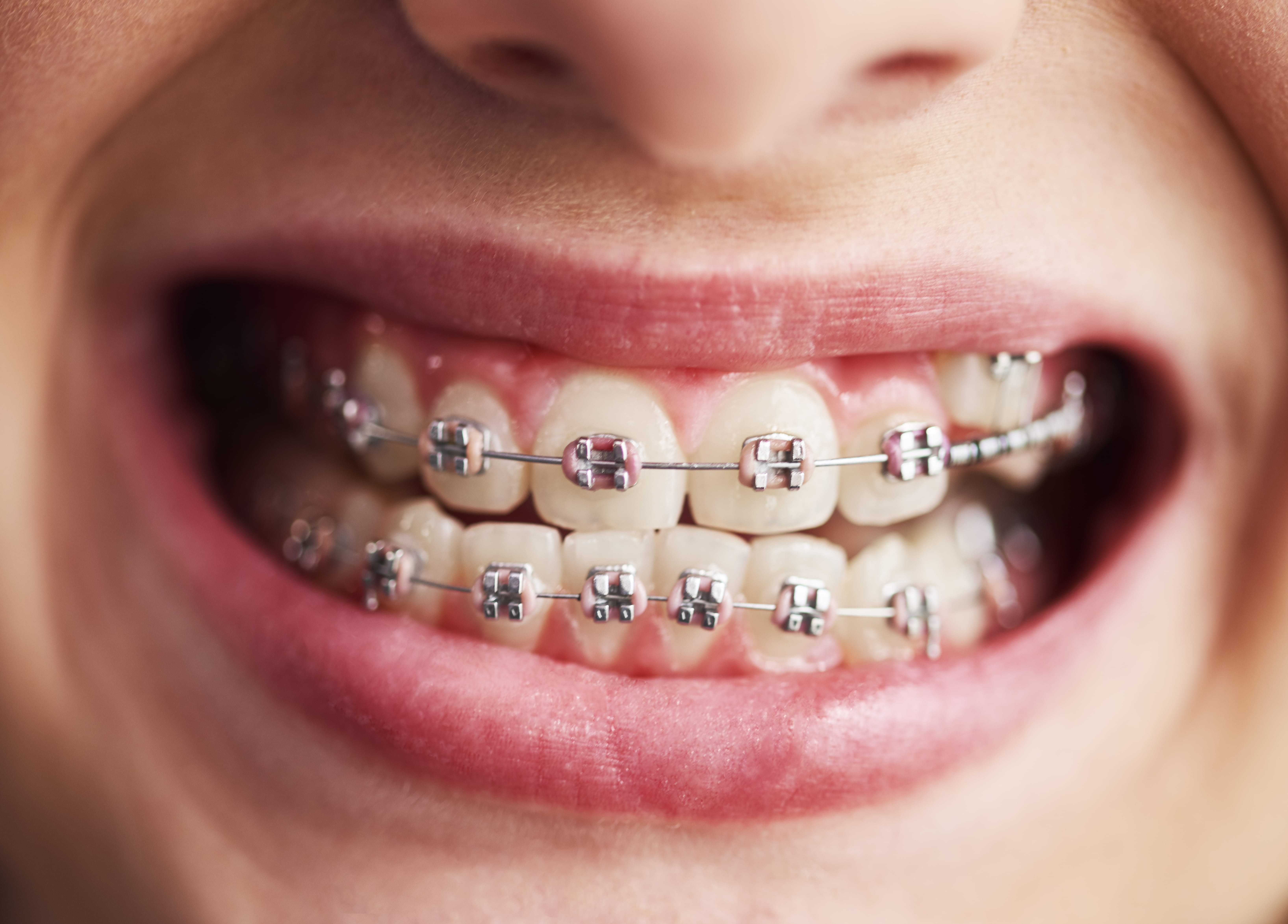 Close-up of a smiling mouth showing teeth with metal braces.