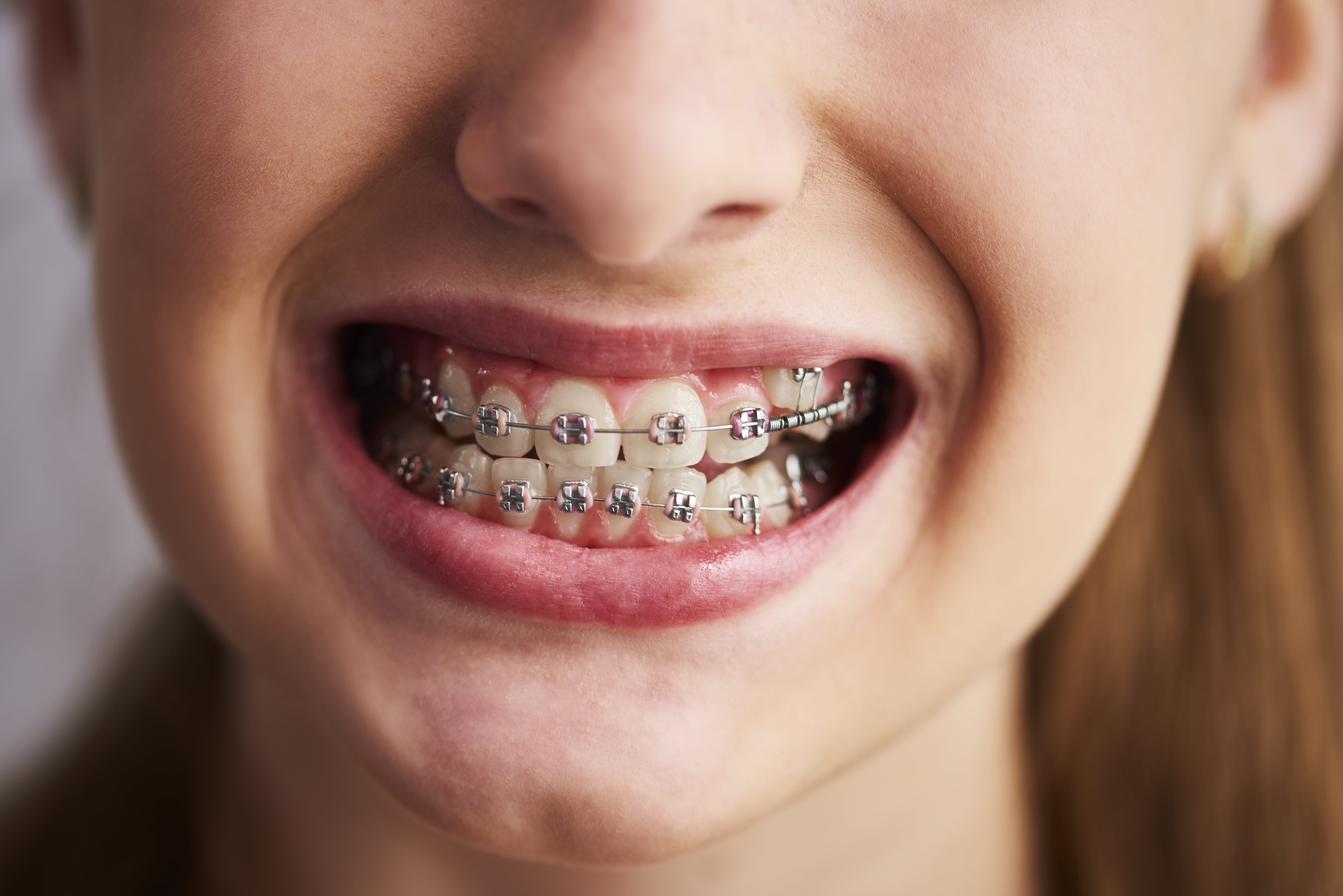 Close-up of a smiling person wearing metal braces on their teeth.