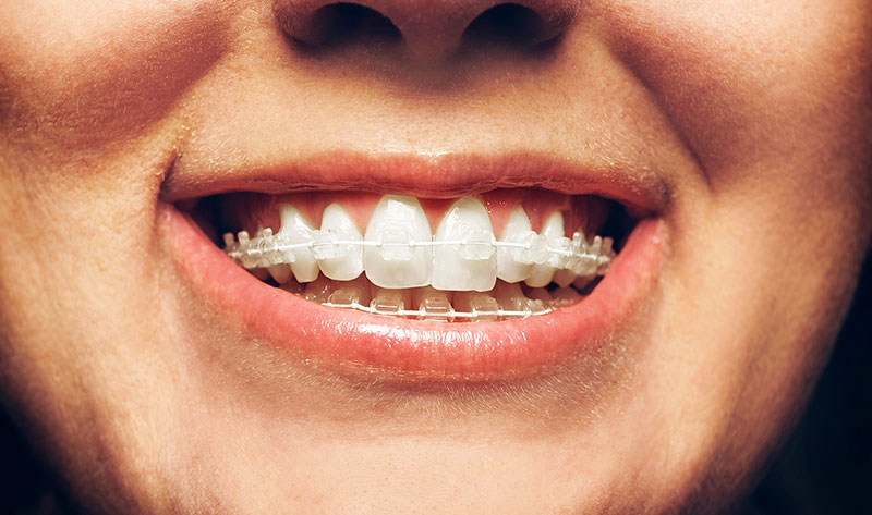 Close-up of a smiling mouth with clear ceramic braces on upper and lower teeth.