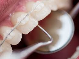 Close-up of dental braces on teeth and a dental tool reflecting in a small mirror.